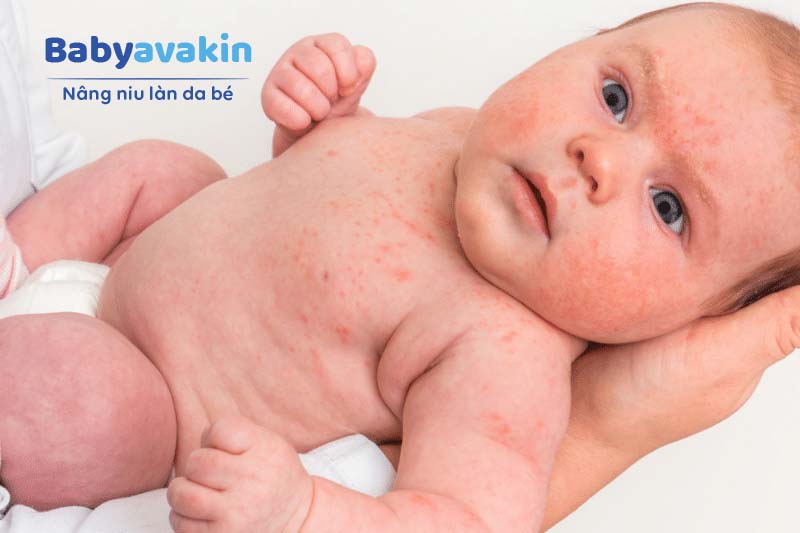 Một số bé bị chàm sữa, mụn sữa có các vết mẩn đỏ như muỗi đốt