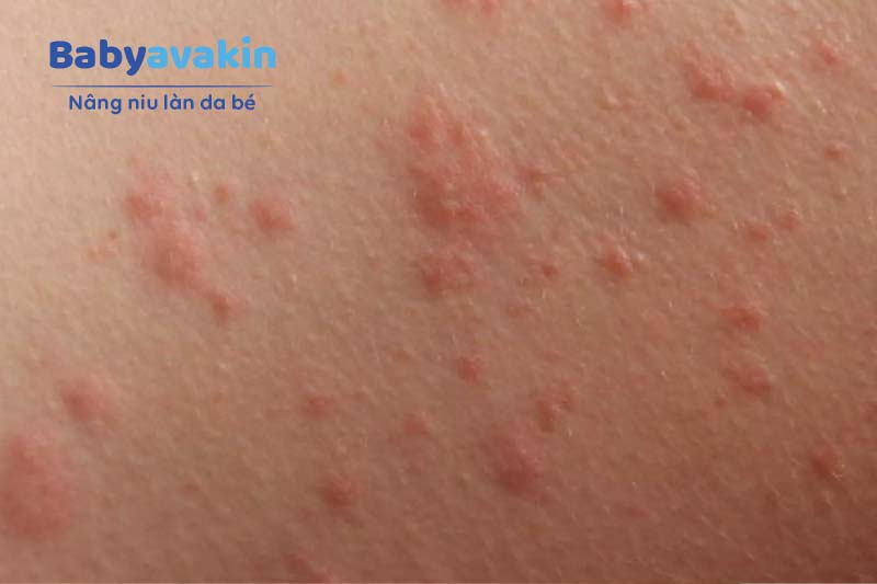 Bé bị mẩn ngứa do muỗi đốt