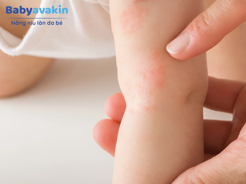 Rôm sảy thường xuất hiện ở tay, chân, cổ, lưng của trẻ