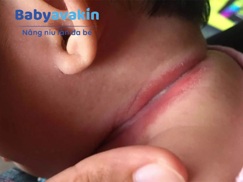 Bé bị hăm cổ