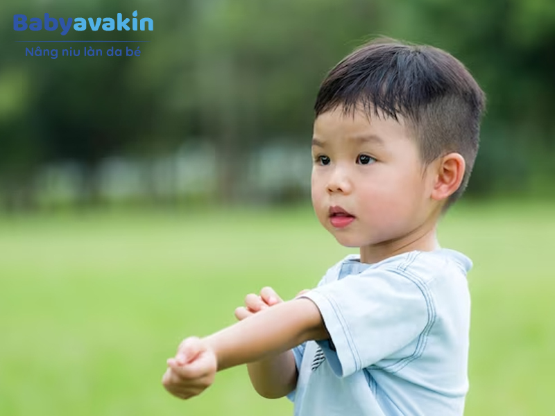 Các bé năng động, tiết nhiều mồ hôi rất dễ gây rôm sảy